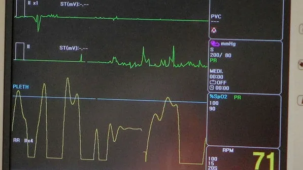 A cardiac monitor displaying ECG traces