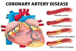 Diagram comparing a healthy artery with arteries progressively narrowed by plaque