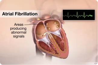 Illustration of the heart showing the upper chambers where atrial fibrillation begins