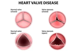 Diagram comparing a normal heart valve with a narrowed one, open and closed